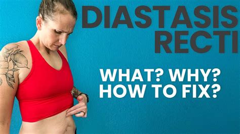 my stomach is too soft to test for diastasis recti|how does diastasis recti look.